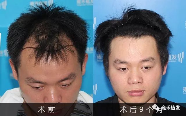 他的植发手术才2小时半植发效果却很好