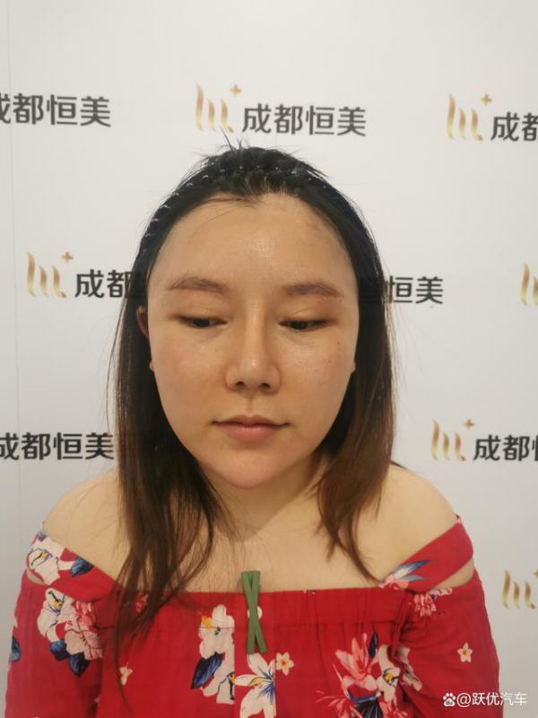 大家要的我在恒美植发的整个过程出炉了