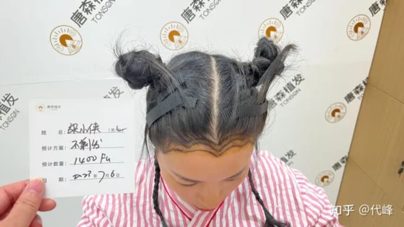 女性发际线植发长短发结合植发案例