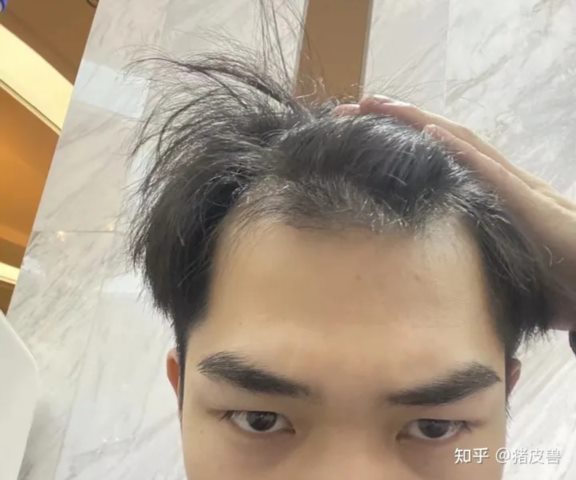 记录我的植发，记录我的植发