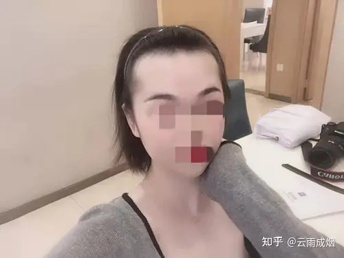 让你少走弯路的大麦植发全记录，且看10个月后效果如何