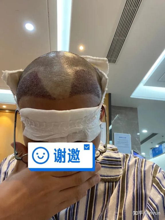 记录一下植发经历吧，记录一下植发经历吧
