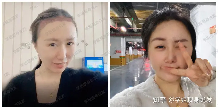 植发手术亲历者终于下车！医院|医生|价格|手术过程|植发危害，植发攻略全在这！