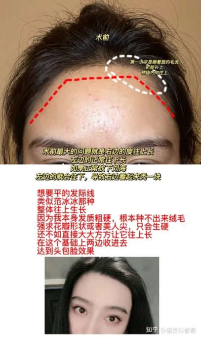 每个城市的真实植发案例投稿