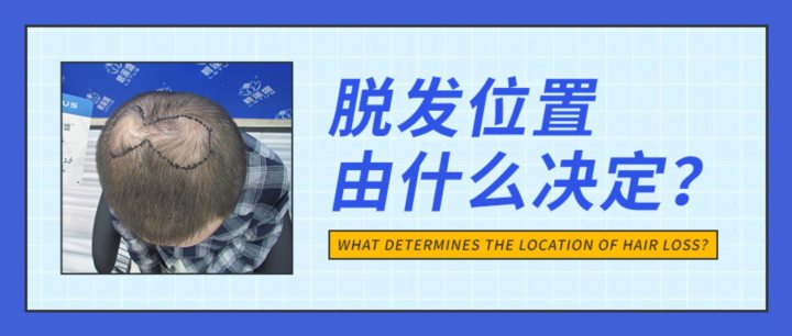 为什么有的人脱发先脱头顶？不同脱发部位说明什么？