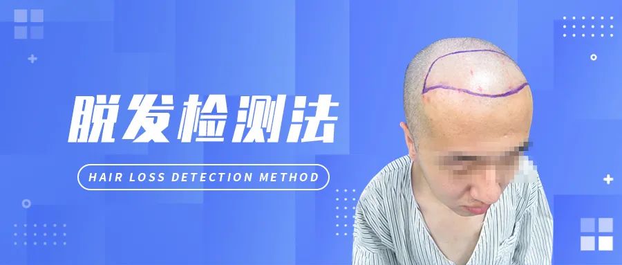 每天掉发量正常，但发旋发缝额角能见头皮了什么情况