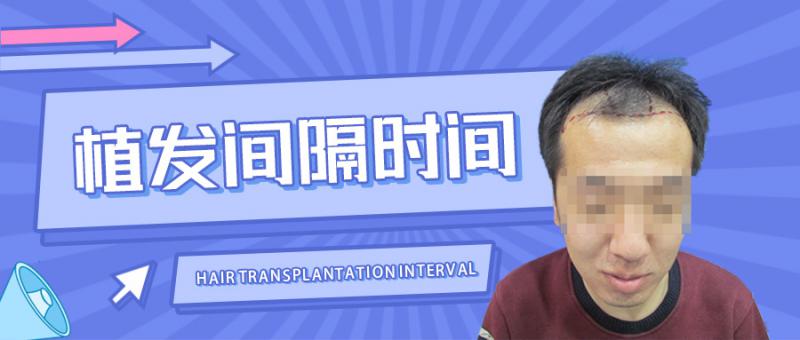 做完一次植发后，多久可以做二次？