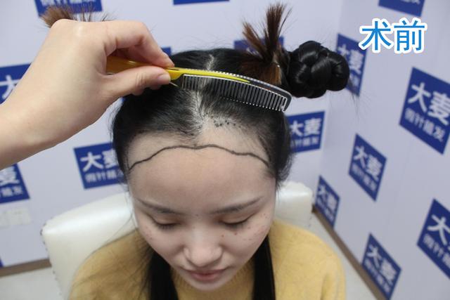 女孩天生发际线高，做植发效果怎么样？
