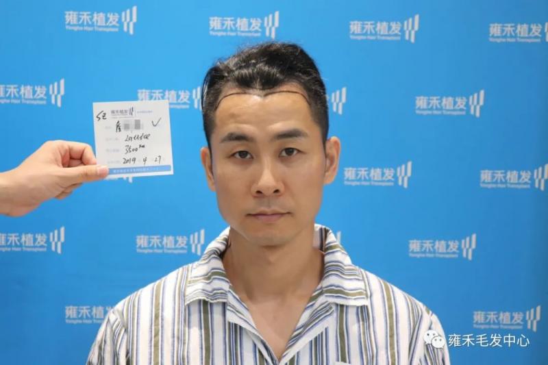 他脱发大家说植发1500单位就够了，可医院植了2700