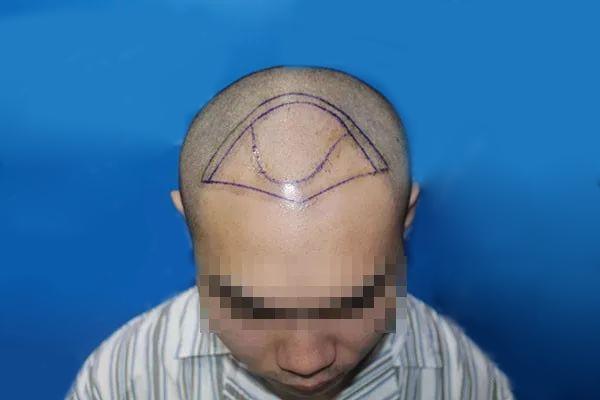 脱发成秃头了怎么办？植发真的能解决问题吗？