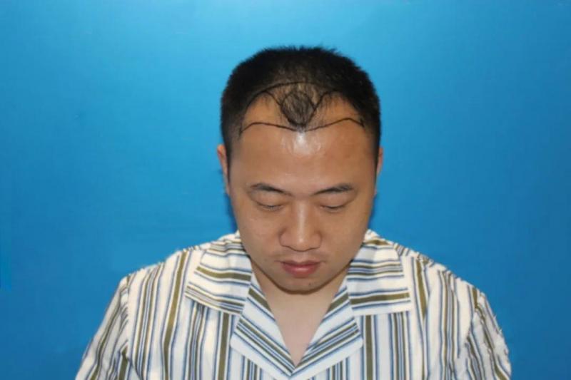 植发效果到底好不好？当初脱发的那些人都怎么样了？