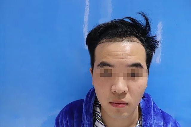 植发究竟能有多好的效果？看看这篇文章你们就知道了