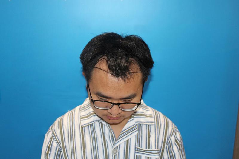 植发初体验！发友：没想到效果竟然这么好