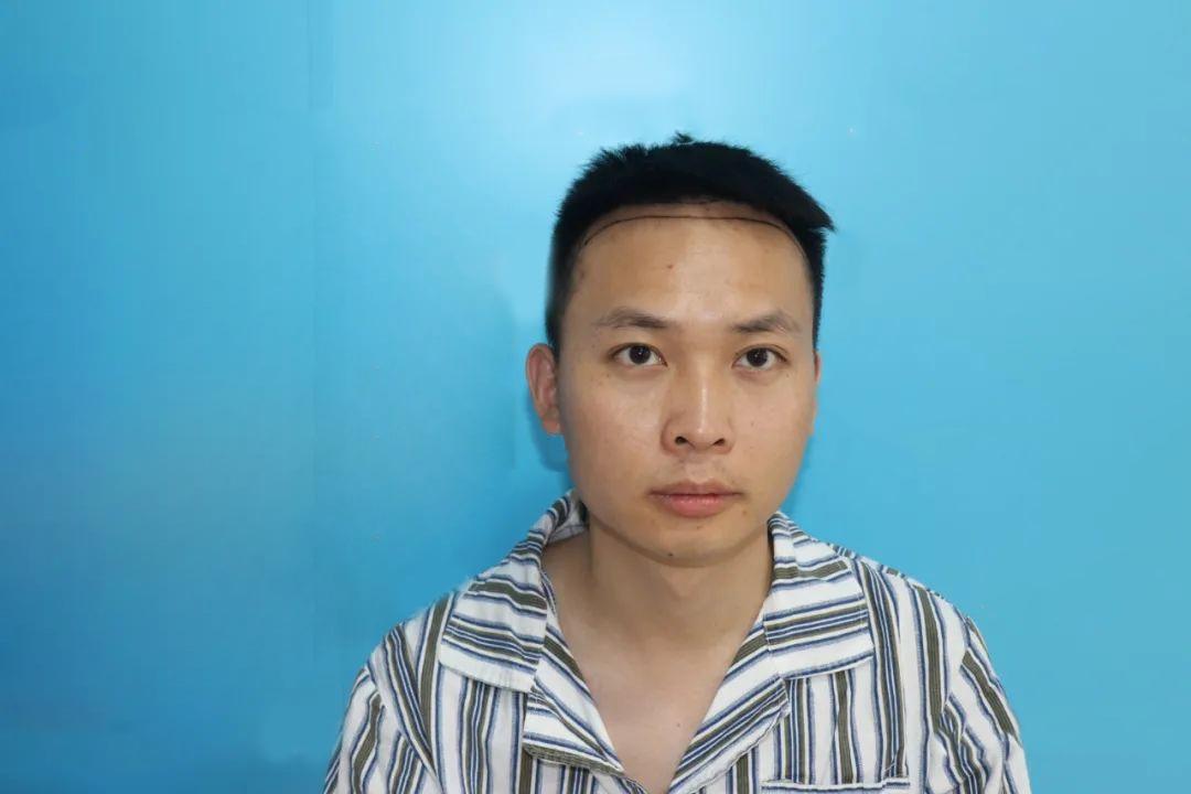 发际线后移怎么治疗？他们整体最后都怎么样了？