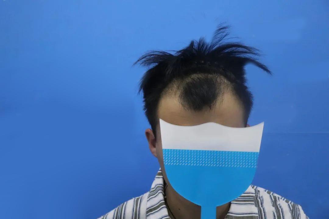植发治疗脱发怎么样？亲身经历分享给你答案