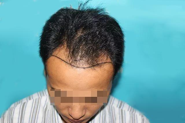 脱发就一定要植发吗？当初脱发的人都怎么样了？