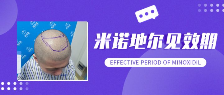 用米诺多长时间没效，就可以植发了？