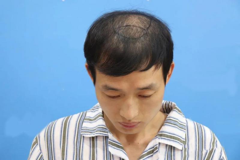 米诺地尔有用？还是植发更有效？医生：缺一不可