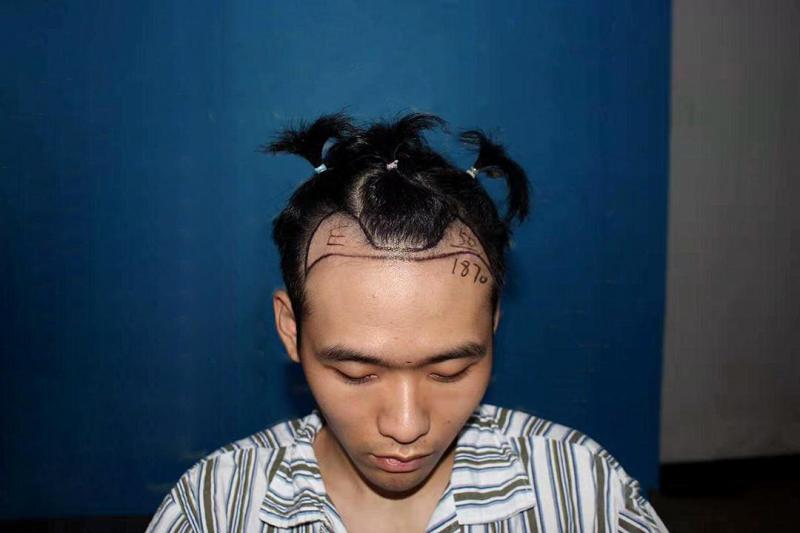 植发是否真的有效？带你揭秘行业内幕