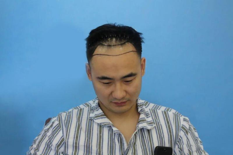 脱发治疗有用吗？看完这个你就懂了