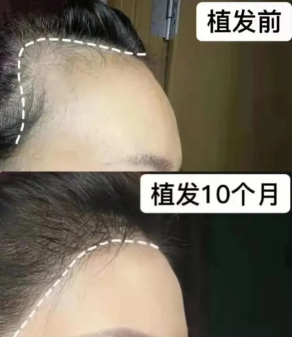 我在大麦植发的经验分享：如何做出原生发际线？