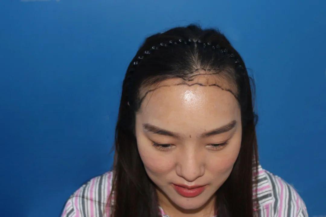 惊人植发量，“我”是不是被医院坑了？