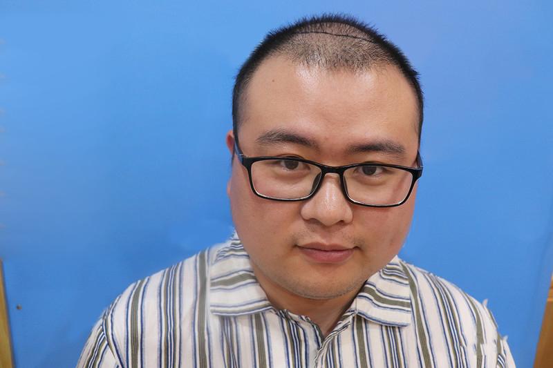 大面积脱发改变不难，找准方法能有效治疗