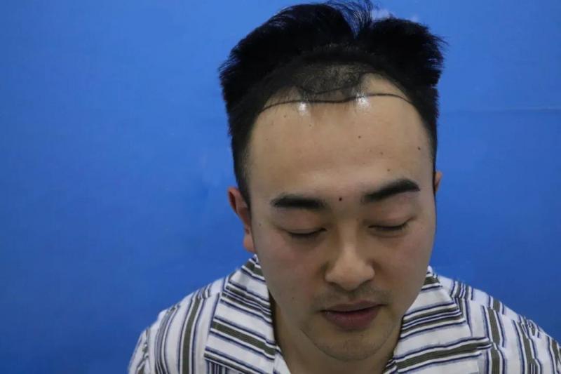 植发半年就焕然一新？是交智商税还是真的有效果？