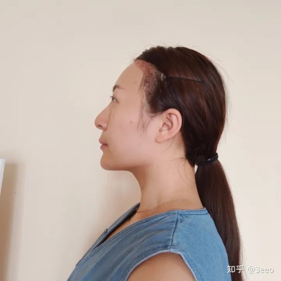 我的植发日记，我为什么要植发呢？