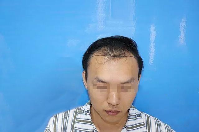 遗传性脱发能治疗吗？他们最后的结局是怎样的？