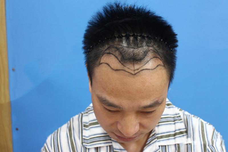 大多数人都脱发，他们都是怎么治疗的？