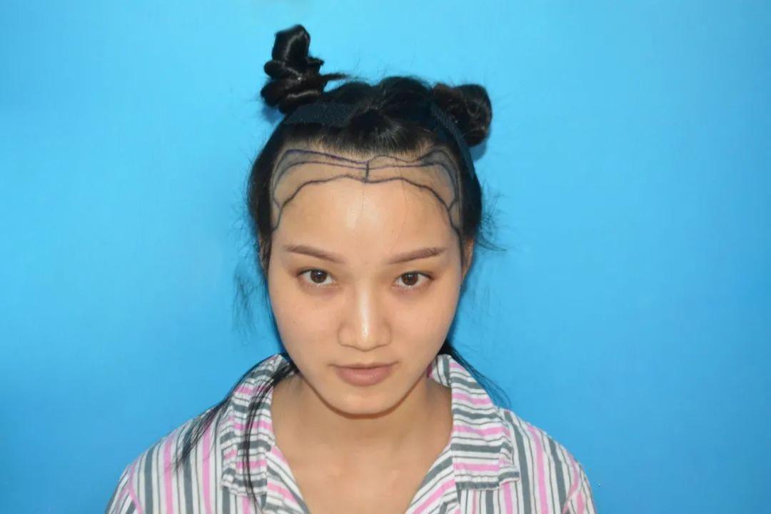 面对脱发，她选择这种方式来改变自己