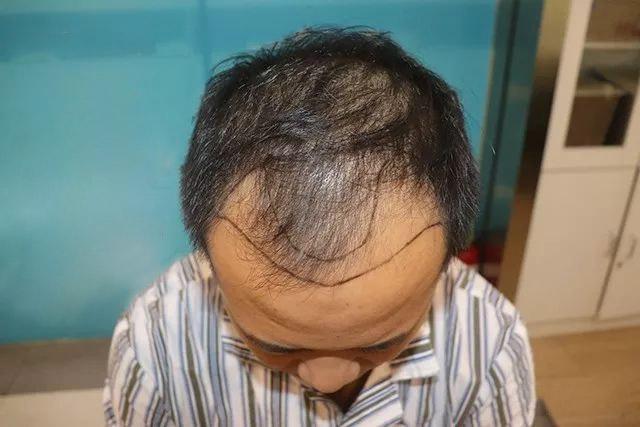 大部分程序员都脱发，他们最后都怎么样了？
