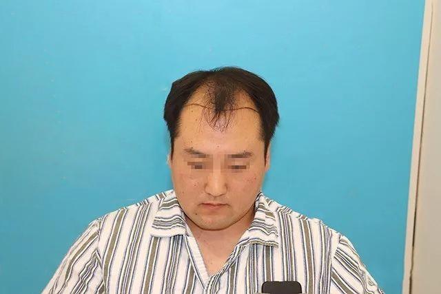 遗传性脱发还有救吗？他们最后都变得怎么样了？