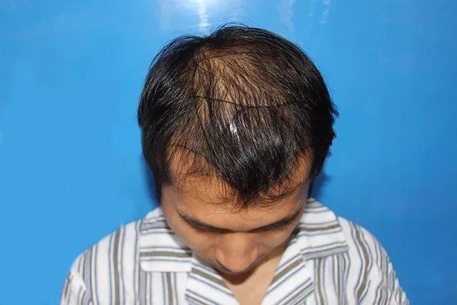 大多数老板都脱发，他们最后都怎么样了？