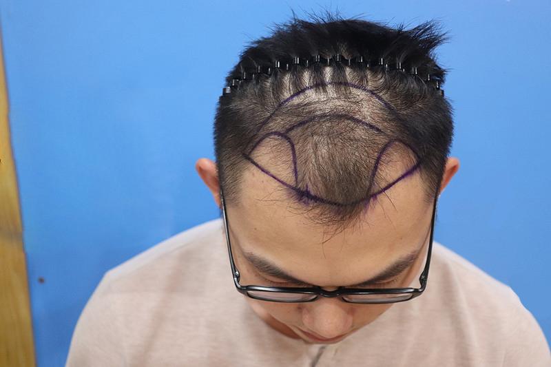 低龄脱发越来越多，植发真的能解决问题吗？