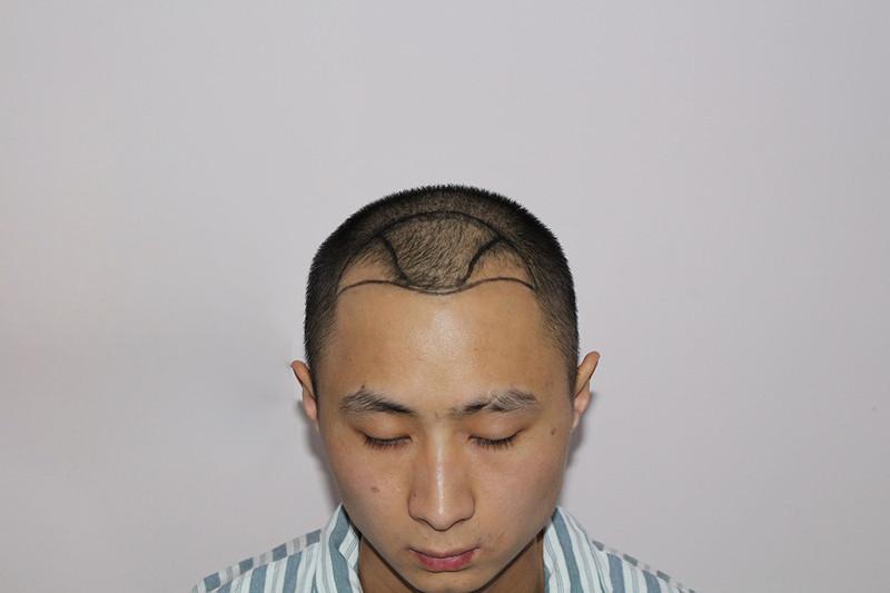 脱发治疗有秘诀吗？发际线高的他是怎么做到的？