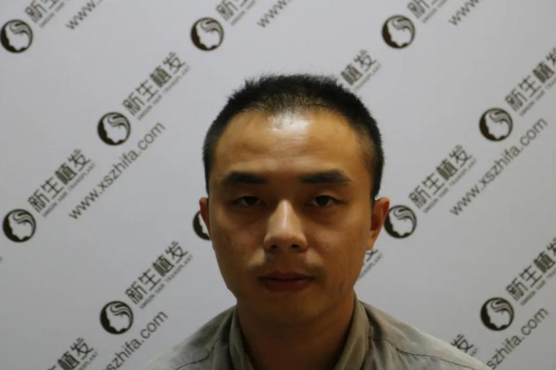二十几岁就头顶稀疏？植发2600单位效果这么好！
