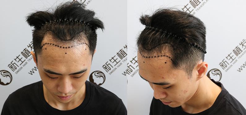 发际线后移严重？看新生3D植发技术一年后效果！