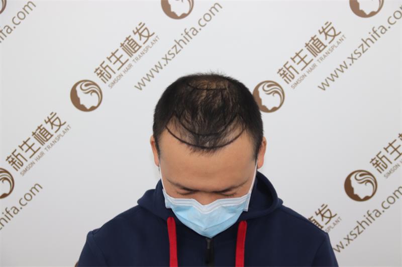 头顶稀疏露头皮，植发3000单位焕然新生！