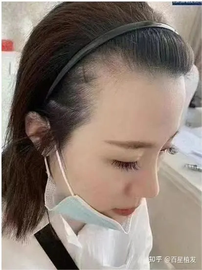 百星植发李女士的植发经历