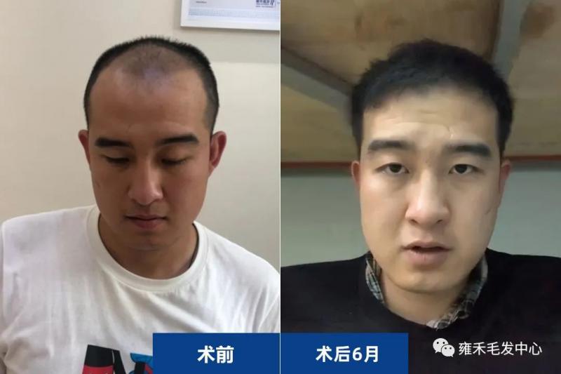石家庄雍禾植发为小丁植发3470单位发际线后退加密植发效果