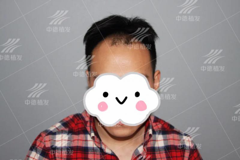 北京中德植发效果看24岁小伙如何走出秃头困境！