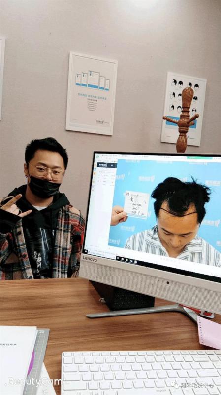 遗传发际秃头旋秃郑州雍禾植发3226毛囊单位