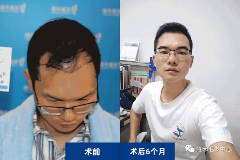 他脱发贷款植发3615单位