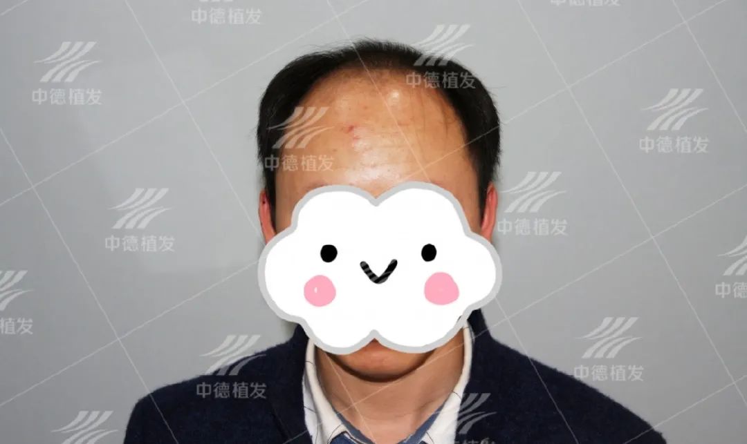 真应该早点找徐霞博士植发我就能早点帅气起来！