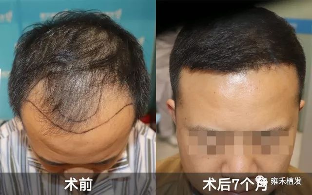 26岁程序员秃了，植发2811单位人帅了