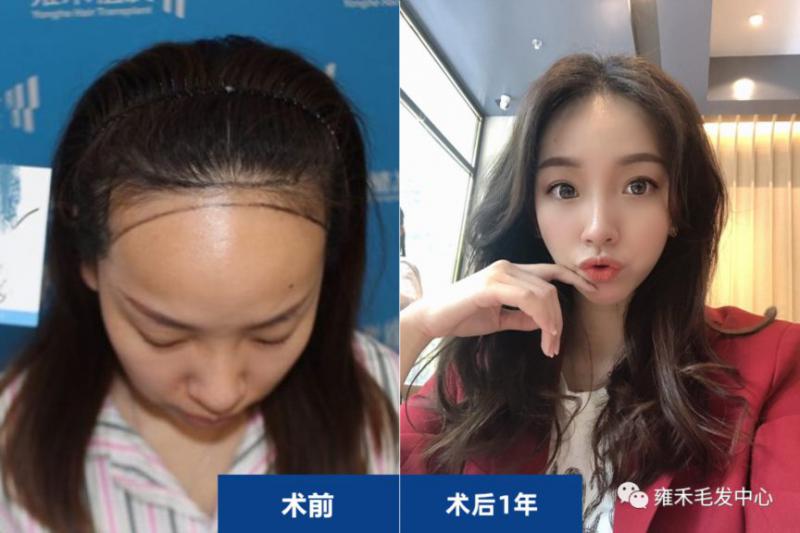 上海植发效果雍禾用FUE为陈女士种植1850单位