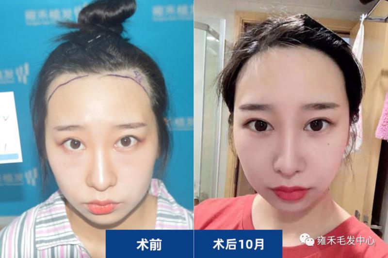 植发要两三万元？美女杭州雍禾植发只花了8000元
