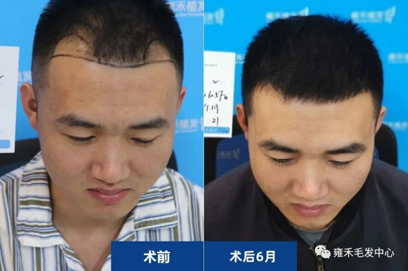 哈尔滨植发雍禾为孙先生植发1756单位让人放心植发
